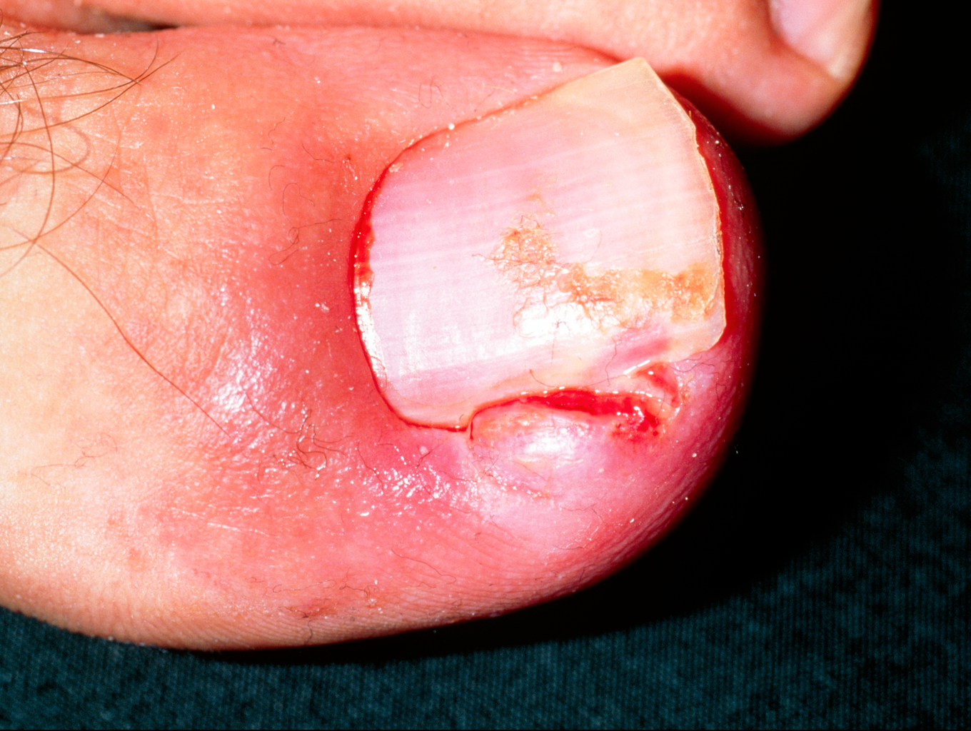 Paronychia Toenail Paronychia Toenail