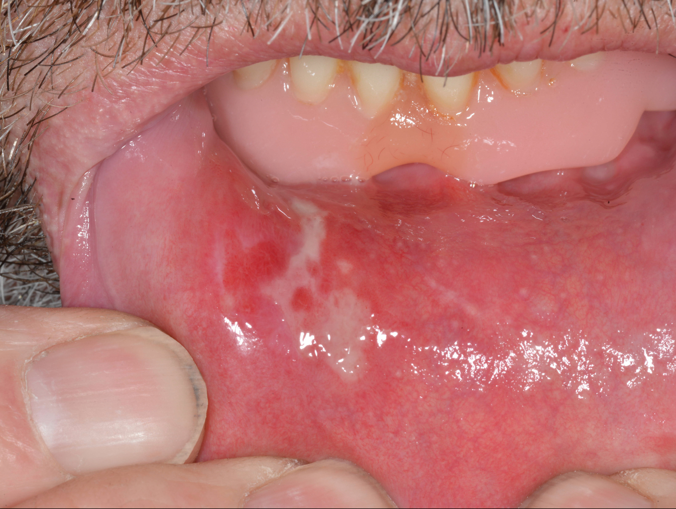 White Spots Inside Lips