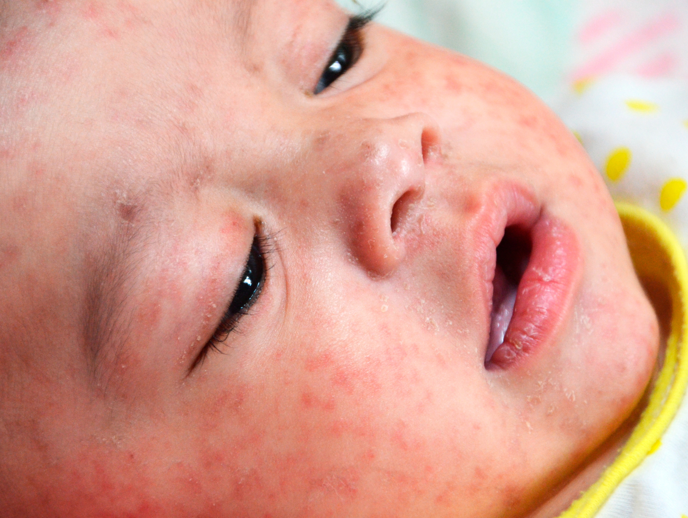 Measle Like Rashes Measles Rash On Face